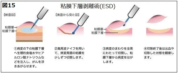 胃癌 | 芦屋三戸岡クリニック